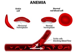 Tackling sickle cell disease